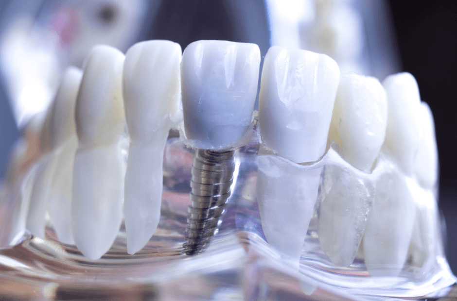 Zahnersatz 2.0: Moderne Implantatprothetik revolutioniert das Lächeln