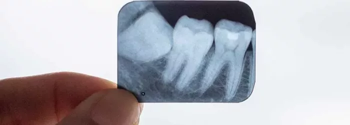 X-ray of wisdom teeth in the dentist's hands